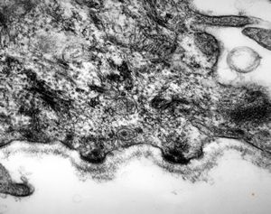 M,7y. | epidermolysis bullosa (dystrophic type) - oral mucosa M,7y. | epidermolysis bullosa (dystrophic type) - oral mucosa